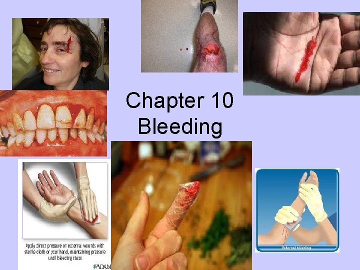 Chapter 10 Bleeding 