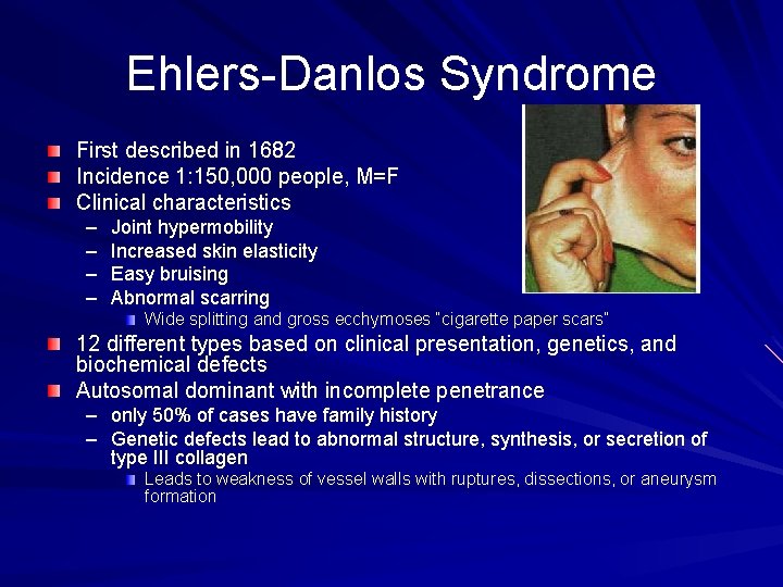 Ehlers-Danlos Syndrome First described in 1682 Incidence 1: 150, 000 people, M=F Clinical characteristics