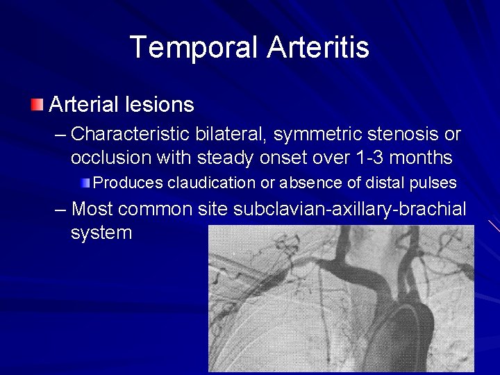 Temporal Arteritis Arterial lesions – Characteristic bilateral, symmetric stenosis or occlusion with steady onset