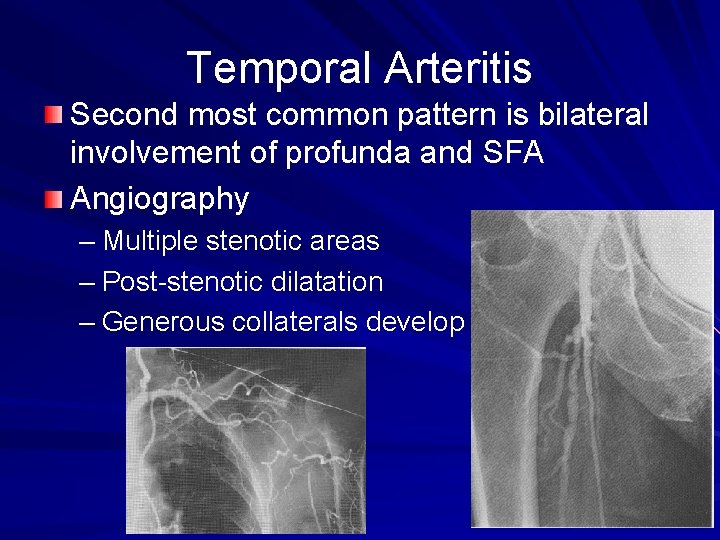 Temporal Arteritis Second most common pattern is bilateral involvement of profunda and SFA Angiography