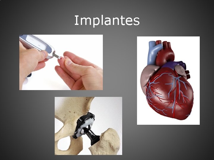 Implantes 