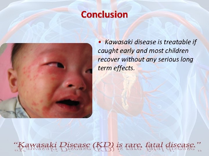 Conclusion • Kawasaki disease is treatable if caught early and most children recover without