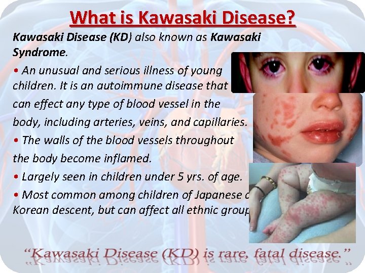 What is Kawasaki Disease? Kawasaki Disease (KD) also known as Kawasaki Syndrome. • An