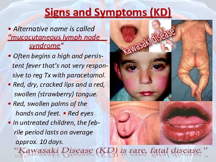 Signs and Symptoms (KD) • Alternative name is called “mucocutaneous lymph node syndrome” •
