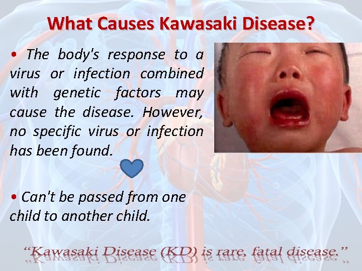 What Causes Kawasaki Disease? • The body's response to a virus or infection combined