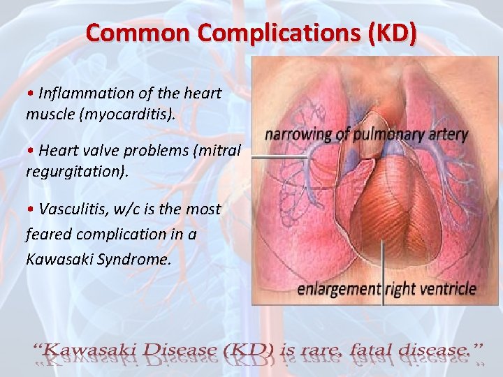 Common Complications (KD) • Inflammation of the heart muscle (myocarditis). • Heart valve problems