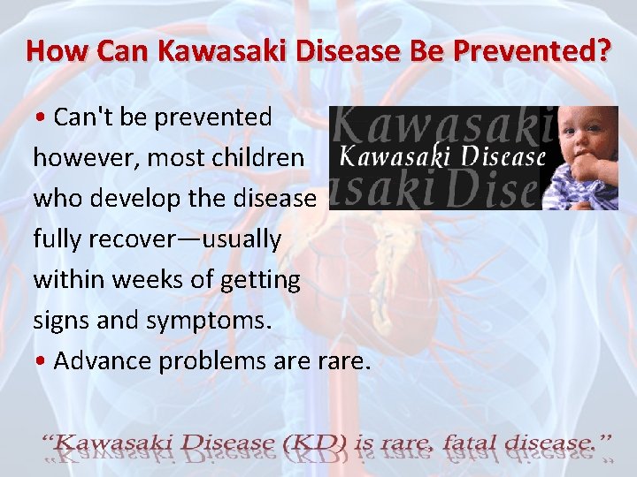 How Can Kawasaki Disease Be Prevented? • Can't be prevented however, most children who