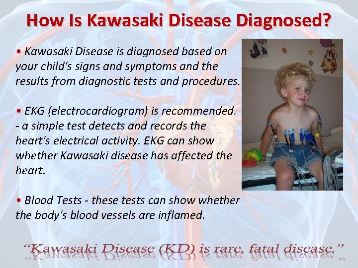 How Is Kawasaki Disease Diagnosed? • Kawasaki Disease is diagnosed based on your child's
