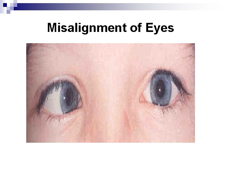 Misalignment of Eyes 