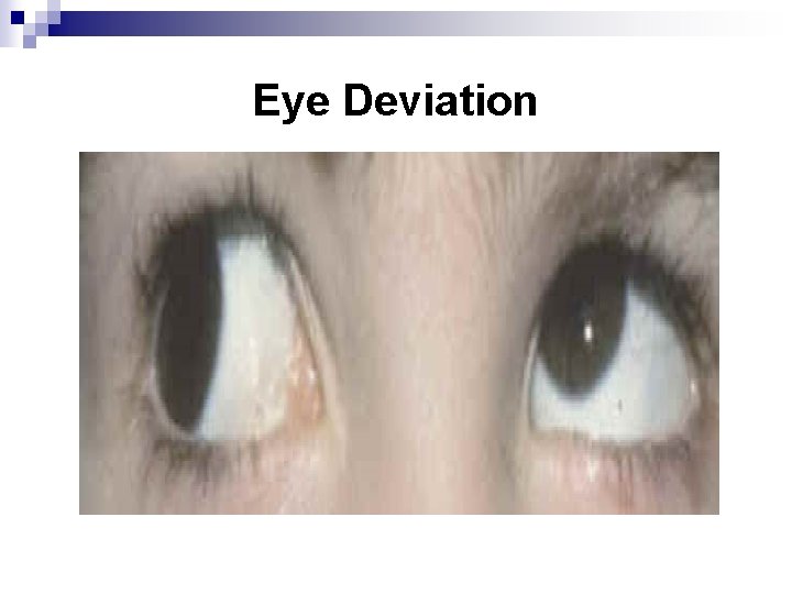 Eye Deviation 