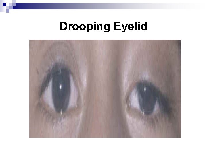 Drooping Eyelid 