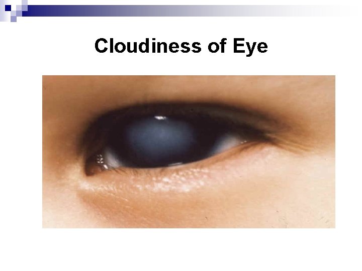 Cloudiness of Eye 