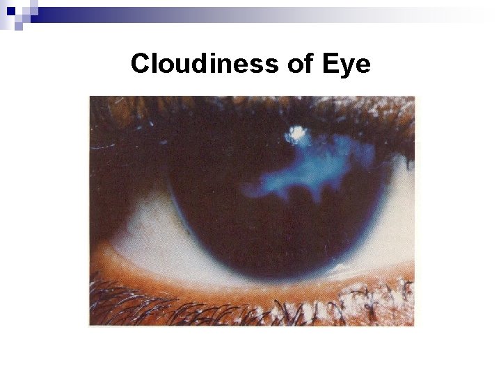 Cloudiness of Eye 