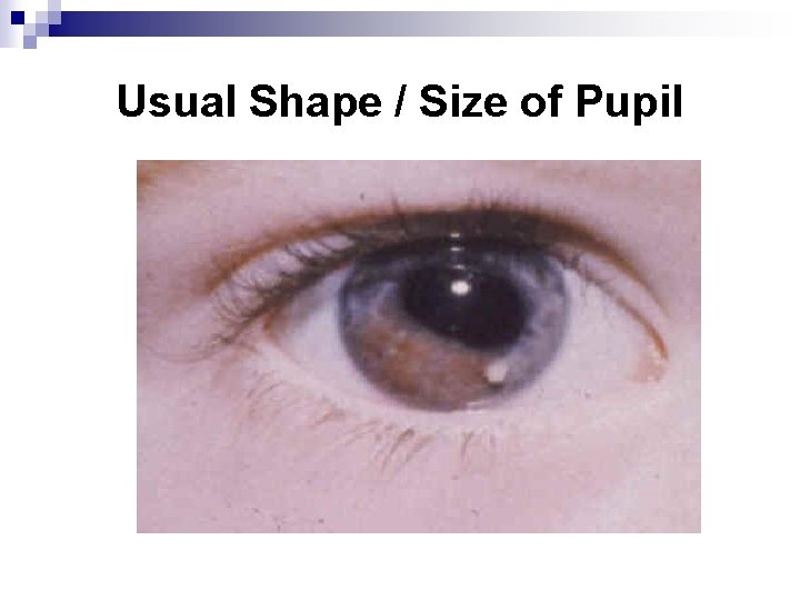 Usual Shape / Size of Pupil 