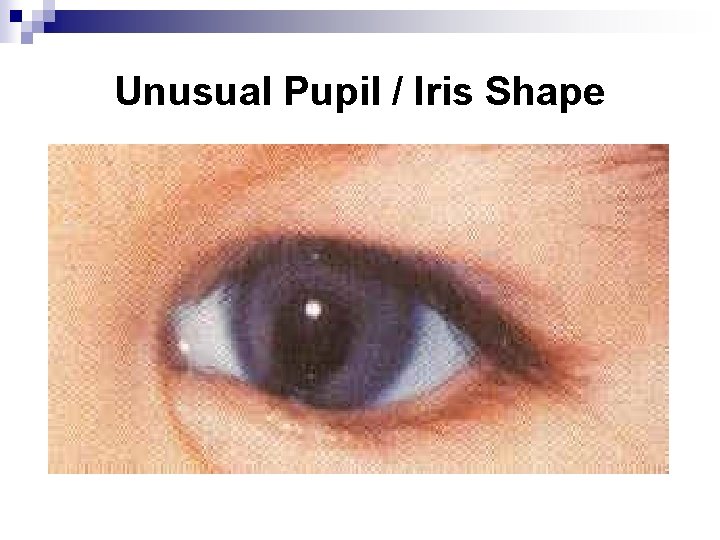 Unusual Pupil / Iris Shape 