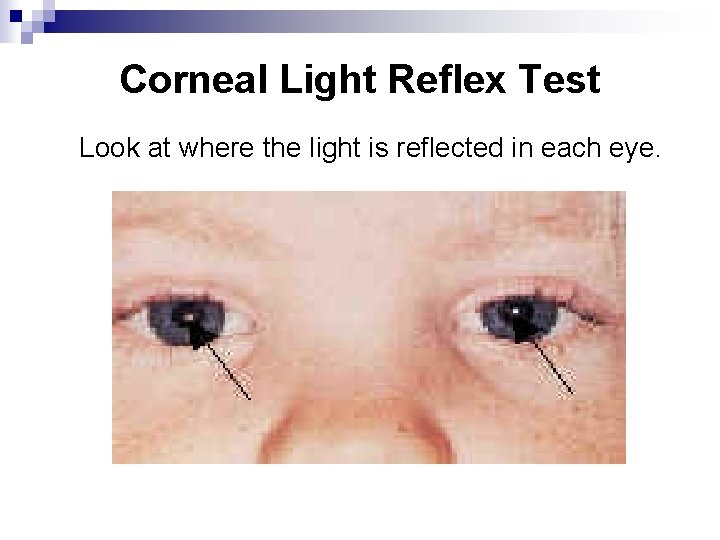 Corneal Light Reflex Test Look at where the light is reflected in each eye.