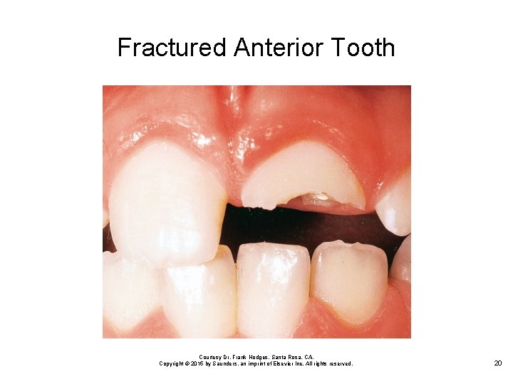 Fractured Anterior Tooth Courtesy Dr. Frank Hodges, Santa Rosa, CA. Copyright © 2015 by