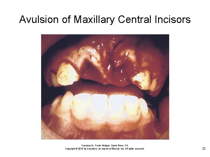 Avulsion of Maxillary Central Incisors Courtesy Dr. Frank Hodges, Santa Rosa, CA. Copyright ©