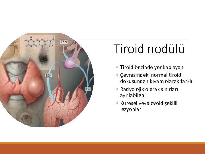 Tiroid nodülü ◦ Tiroid bezinde yer kaplayan ◦ Çevresindeki normal tiroid dokusundan kıvam olarak