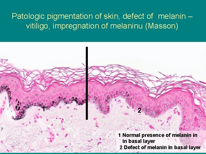 Patologic pigmentation of skin, defect of melanin – vitiligo, impregnation of melaninu (Masson) 1