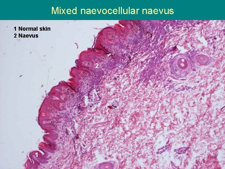 Mixed naevocellular naevus 1 Normal skin 2 Naevus 2 1 
