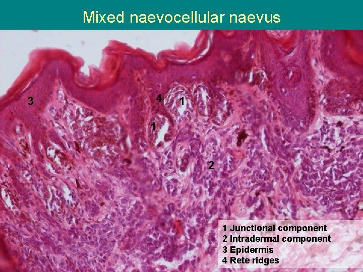 Mixed naevocellular naevus 3 4 1 1 2 1 Junctional component 2 Intradermal component