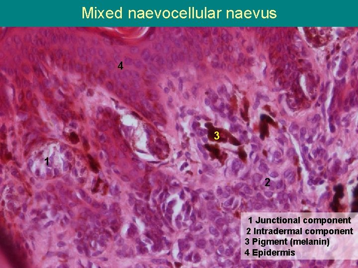 Mixed naevocellular naevus 4 3 1 2 1 Junctional component 2 Intradermal component 3
