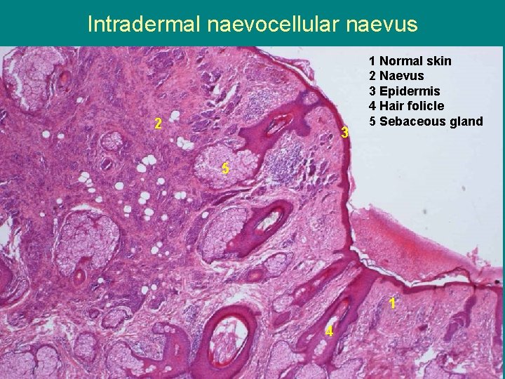 Intradermal naevocellular naevus 2 3 1 Normal skin 2 Naevus 3 Epidermis 4 Hair