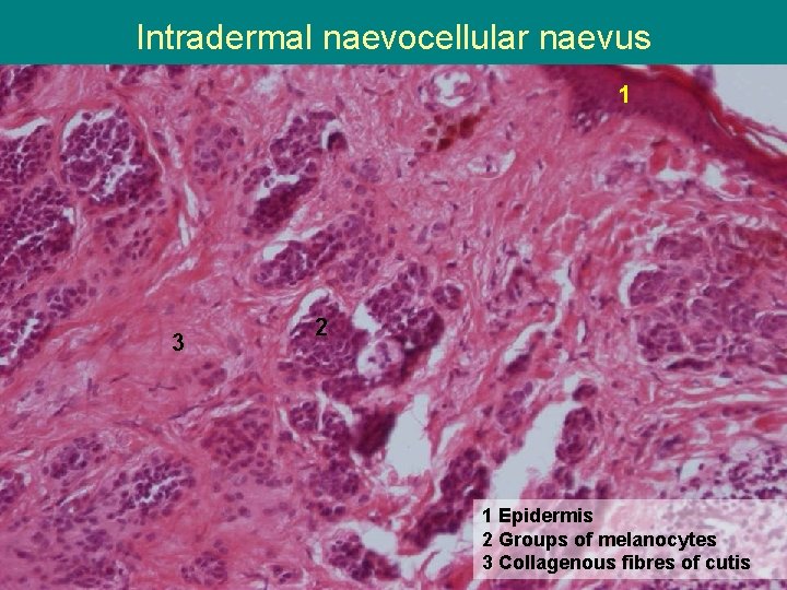 Intradermal naevocellular naevus 1 3 2 1 Epidermis 2 Groups of melanocytes 3 Collagenous