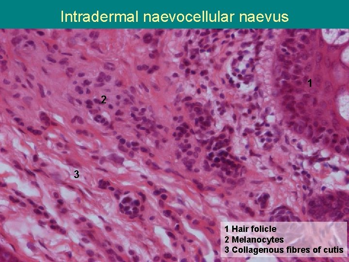 Intradermal naevocellular naevus 1 2 3 1 Hair folicle 2 Melanocytes 3 Collagenous fibres