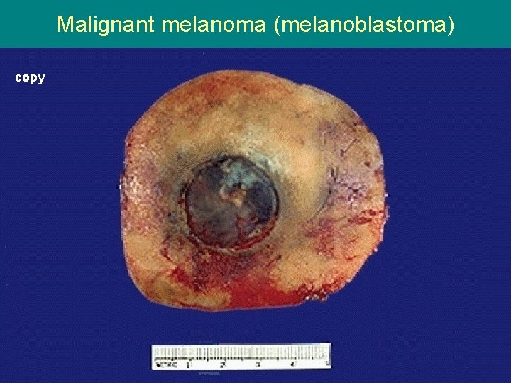 Malignant melanoma (melanoblastoma) copy 