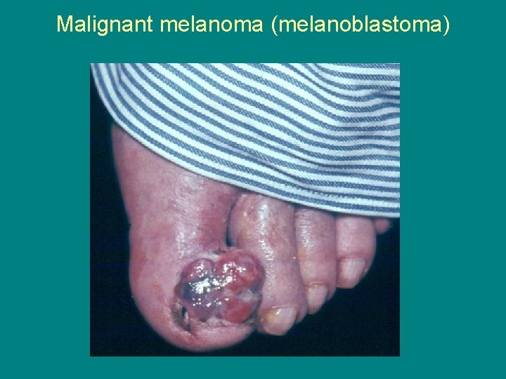 Malignant melanoma (melanoblastoma) 