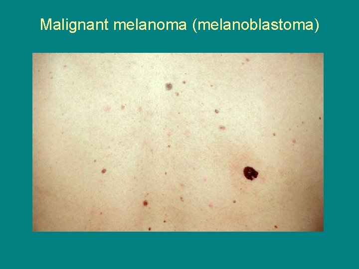 Malignant melanoma (melanoblastoma) 