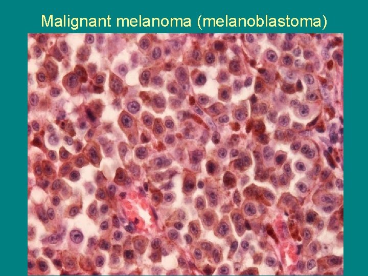 Malignant melanoma (melanoblastoma) 