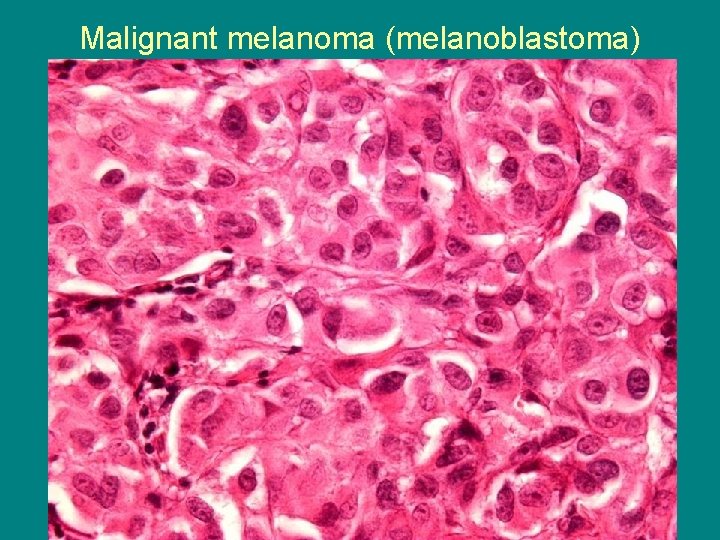 Malignant melanoma (melanoblastoma) 