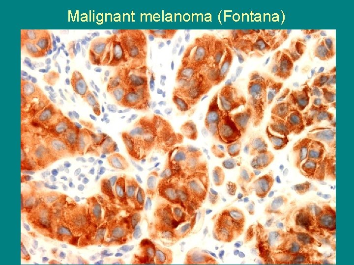 Malignant melanoma (Fontana) 