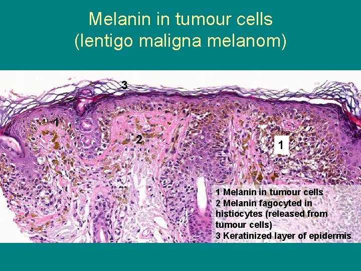 Melanin in tumour cells (lentigo maligna melanom) 3 1 2 1 1 Melanin in