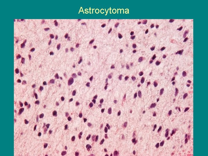 Astrocytoma 
