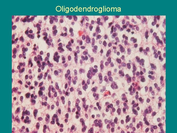 Oligodendroglioma 