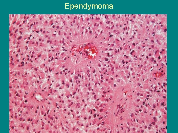 Ependymoma 