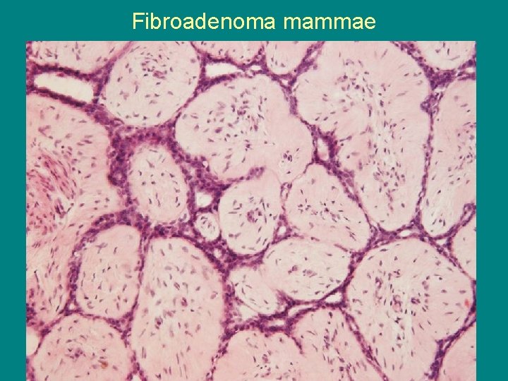 Fibroadenoma mammae 