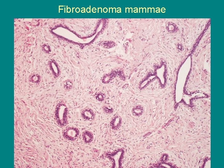 Fibroadenoma mammae 