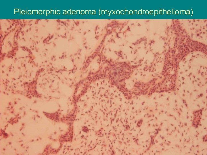 Pleiomorphic adenoma (myxochondroepithelioma) 