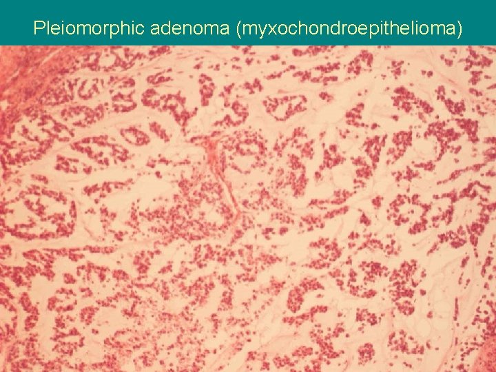 Pleiomorphic adenoma (myxochondroepithelioma) 