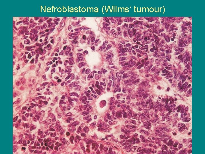 Nefroblastoma (Wilms‘ tumour) 