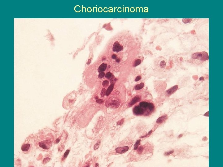 Choriocarcinoma 