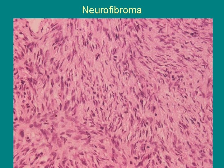 Neurofibroma 