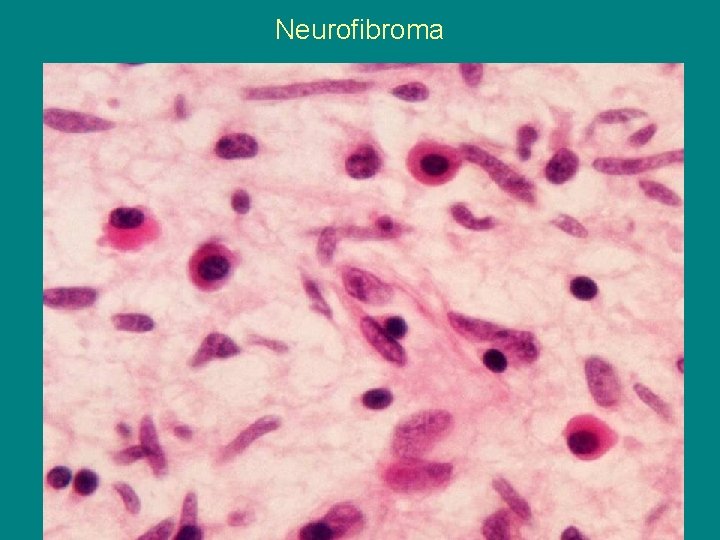 Neurofibroma 