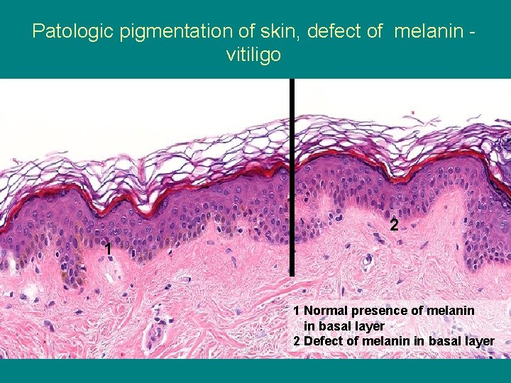 Patologic pigmentation of skin, defect of melanin vitiligo 2 1 1 Normal presence of