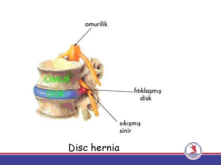 Disc hernia 